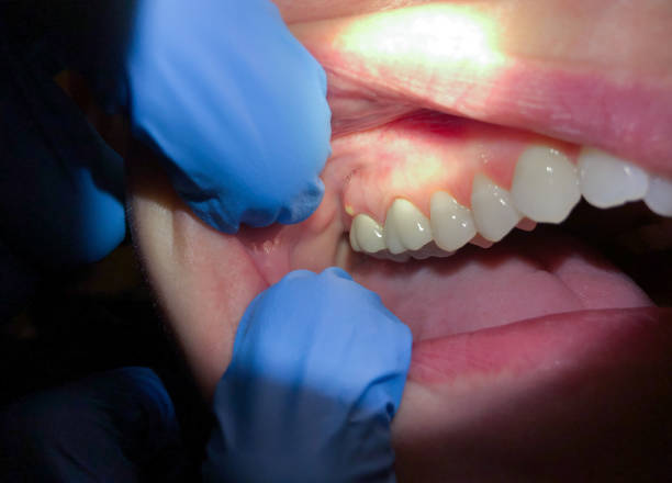 Best Urgent Care for Lost Fillings or Crowns in Jonestown, PA
